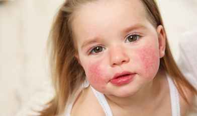 Атопический дерматит у детей и взрослых: причины, симптомы, лечение, санатории на 2022 год