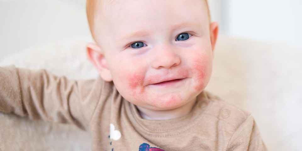 Санаторий для лечения дерматита у детей