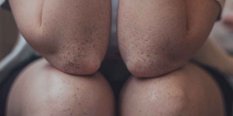 Профилактика артроза