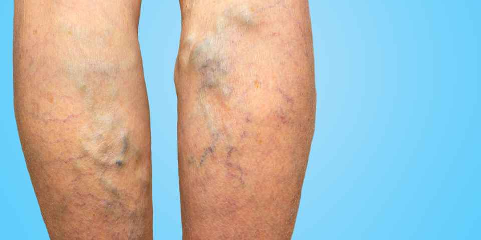 Санатории лечащие варикоз